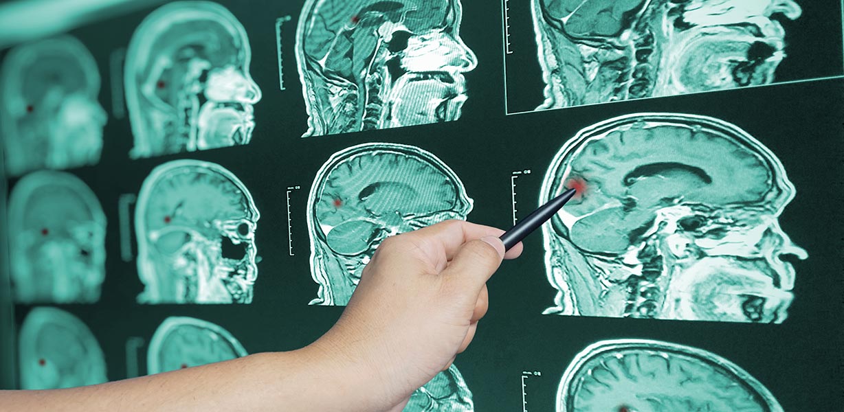 A doctor's arm pointing at images of brain scans Brain Injuries